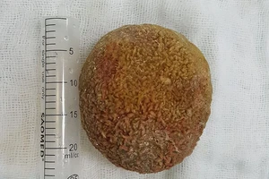 Phẫu thuật lấy viên sỏi bàng quang kích thước 'khủng'