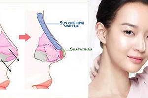 Phẫu thuật nâng mũi S line có được vĩnh viễn không?