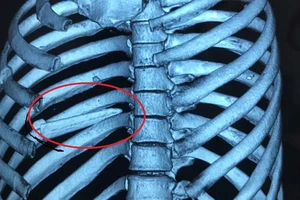 Cứu sống một người bị đâm thấu phổi bằng mũi cá kiếm