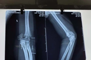 3 giờ phẫu thuật nối cánh tay cho Thượng úy Hoàng Văn Dương 