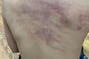 Hải Phòng yêu cầu công an vào cuộc điều tra vụ cháu bé nghi bị bạo hành tại trường mầm non An Dương