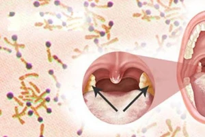 Bệnh bạch hầu có chữa khỏi hẳn được không?