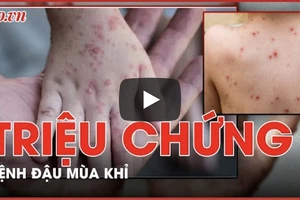 Nhận biết các triệu chứng nghi ngờ đậu mùa khỉ để điều trị kịp thời