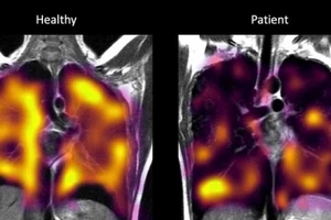 Anh có phát hiện quan trọng, mở ra hy vọng chấm dứt di chứng hậu COVID-19