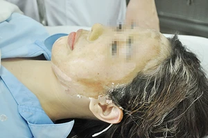 Nữ sinh bị tạt acid có thể hỏng mắt