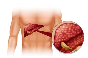 Các yếu tố giúp giảm nguy cơ mắc bệnh gan nhiễm mỡ
