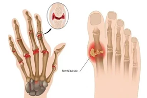 Những dấu hiệu sớm của tình trạng axit uric cao cần chú ý