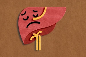  7 dấu hiệu cảnh báo gan đang tổn thương dù bạn không hề uống rượu