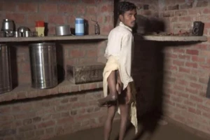 Hi hữu chàng trai Ấn Độ có 4 chân