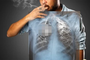 Giải quyết gánh nặng ung thư: Cần xem xét đến các giải pháp giảm tác hại