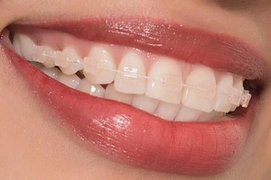 Niềng răng mắc cài sứ là gì?