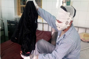 Bóng bay phát nổ, cả nhà bị cháy khắp mặt 