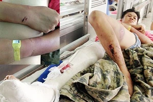 Bắt giam cha cô gái trong vụ “bị gia đình bạn gái còng, đánh gãy chân“