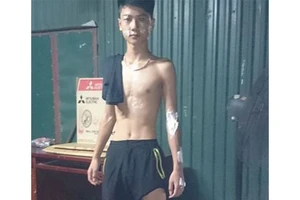 Trốn CSGT, xe chở axit gây bỏng hàng loạt người đi đường