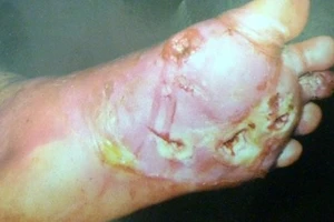 Bia rượu 'tàn phá' dân nhậu khủng khiếp như thế nào?