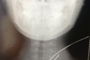 Cứu sống bé trai bị cọng sắt đâm xuyên cổ