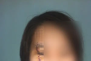 Cô gái bị rạch mặt khi uống nước mía bên đường