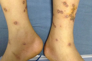 Cứu sống trẻ bị ong vò vẽ đốt gần 170 mũi