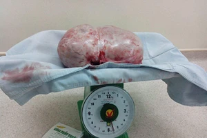 Bóc tách thành công khối u buồng trứng nặng gần 6kg