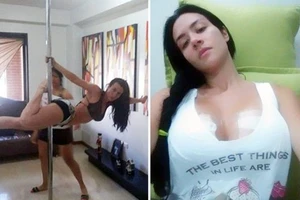Cựu người mẫu Venezuela vỡ túi ngực khi múa cột