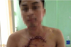 Cứu sống bệnh nhân bị tai nạn, tim phổi lộ ra ngoài thành ngực