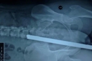 Cấp cứu 1 bệnh nhân bị thanh sắt đâm vào mông