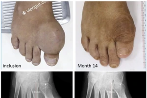 Viện Gút TP.HCM điều trị khỏi bệnh gút theo tiêu chuẩn nào?