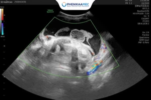 U nang buồng trứng có nguy hiểm không? Trường hợp nào cần mổ ngay?