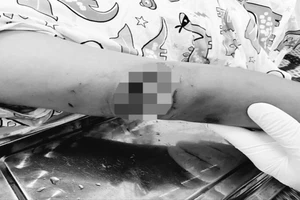 Bé gái bị chó cắn với vết thương sâu phải nhập viện cấp cứu 