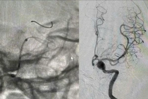 Can thiệp thành công ca bệnh có 'bom nổ chậm' trong não