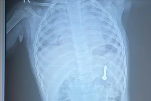 Nội soi gắp đinh vít trong dạ dày bé 21 tháng tuổi