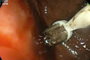 Nam thanh niên nuốt 3 bàn chải đánh răng