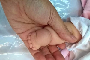 Tay chân bé có ngấn tưởng bụ bẫm, hóa ra bệnh lạ