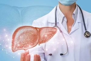 5 loại thực phẩm hại gan hơn bia rượu