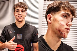 "Ẵm" trọn gầm giầy, hậu vệ Barca khâu 10 mũi