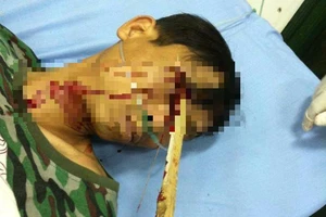 Cứu sống bệnh nhân bị cọc nhọn đâm trúng mắt vào não