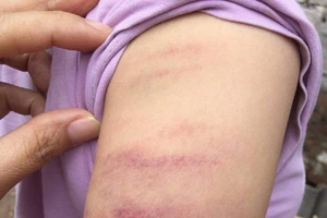 Không làm bài tập, học sinh bị cô giáo đánh tím tay