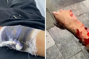 Đi xem Euro về, thiếu niên 17 tuổi bị nhóm cướp chém trọng thương và lấy đi xe máy