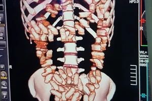 Cô gái ngoại quốc nuốt... 1,26 kg cocain vào bụng