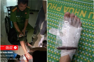 Trưởng Công an xã ở Quảng Ngãi bị gỗ đâm xuyên chân khi giúp dân chống lũ