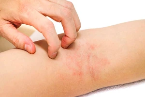 Cách chăm sóc đúng cho người bị viêm da cơ địa