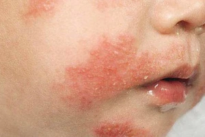 Cảnh báo dị ứng đạm sữa bò