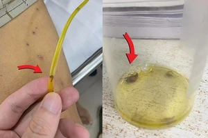 Hi hữu: Sán lá gan lổm ngổm chui ra từ ống mật