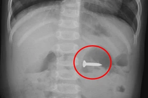 Đinh vít sắc nhọn trong bụng bé gái 2 tuổi