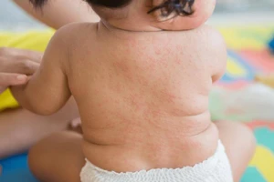 Hậu COVID-19 ở trẻ, nổi ban đỏ, khó thở thì đi khám ngay