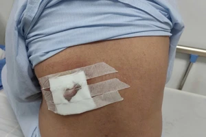 Lấy lá đắp để điều trị mụn, 1 bệnh nhân bị hoại tử vùng lưng