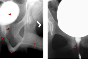 Cứu bé gái khỏi nguy cơ cắt thận vì bị bệnh hiếm gặp