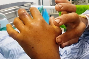 Suýt mất mạng vì chữa rắn cắn bằng thuốc Nam 