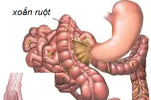 Cứu sống bé sơ sinh mắc bệnh xoắn ruột hiếm gặp​