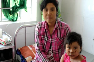 Anh trai nhóm lửa bằng xăng làm em gái bỏng nặng